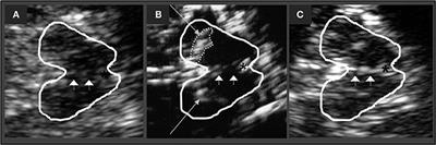 Brainstem Raphe Alterations in TCS: A Biomarker for Depression and Apathy in Parkinson's Disease Patients